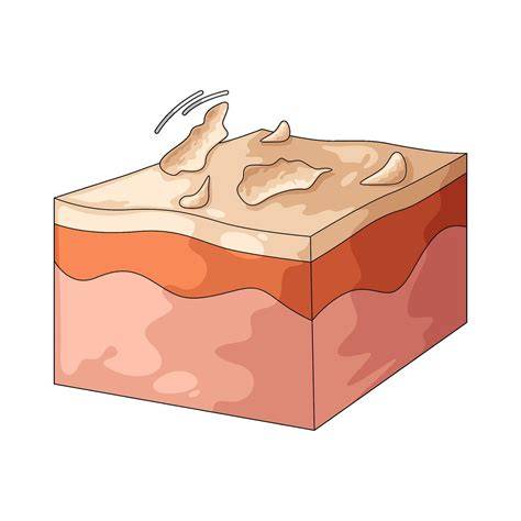 illustration peeling Innerskin types