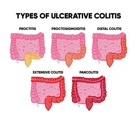 infographie sur les types de colites et leurs symptômes