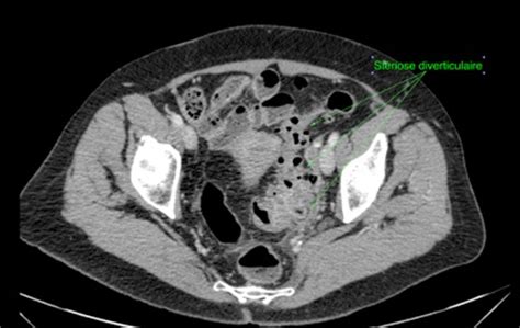 Scanner abdominal montrant des diverticules