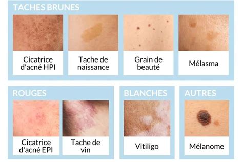Carte du corps montrant les zones typiques de taches pigmentaires