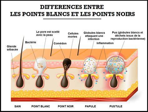 Infographie: Formation des points noirs et rôles des glandes sébacées