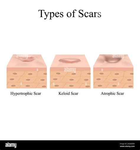 Schéma: Types de cicatrices d'acné
