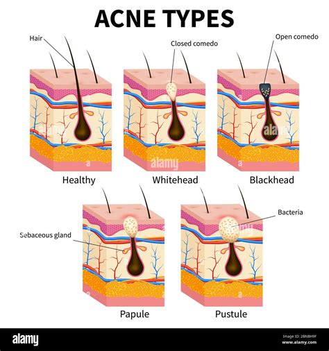 schéma-types-cicatrices-acne