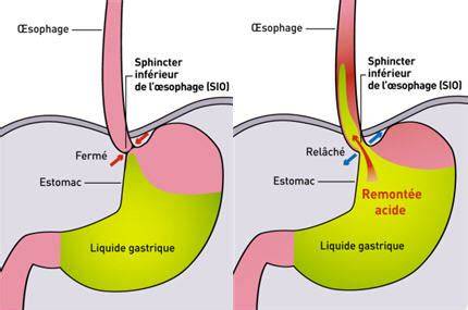 schéma du sphincter œsophagien inférieur et reflux