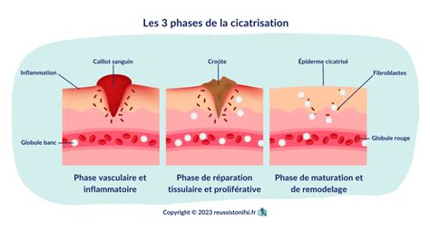 Schéma illustrant les différentes phases de la cicatrisation d'une plaie